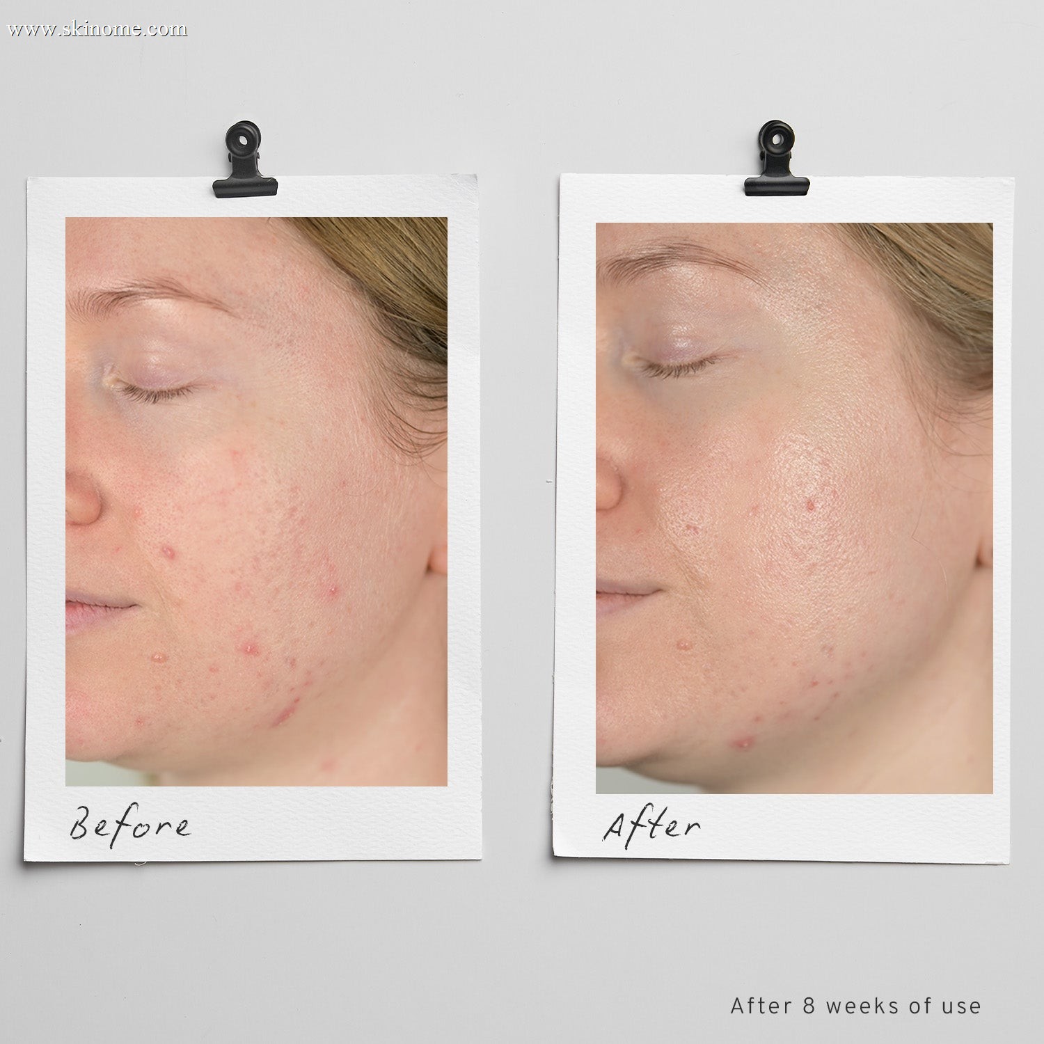 skinome_web26_azeret_before_after_1x1_d95b4212-0a5e-4038-8f76-4a9cd4e6c80d.jpg